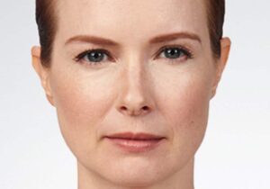 a woman frowning after botox treatment