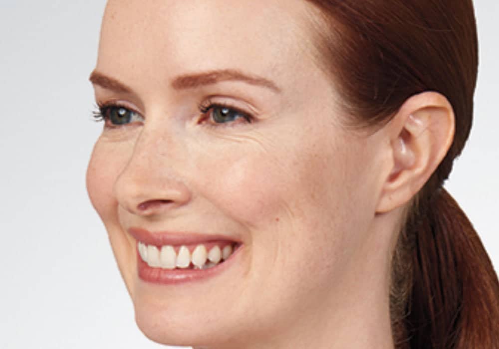 a woman smiling after botox