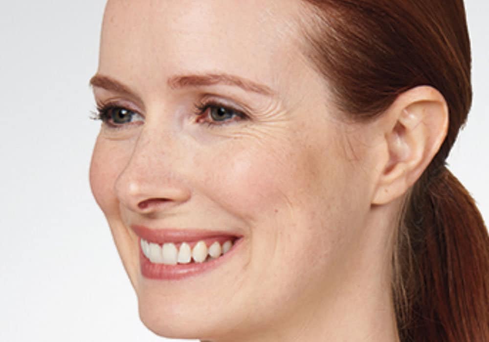 a woman smiling before botox