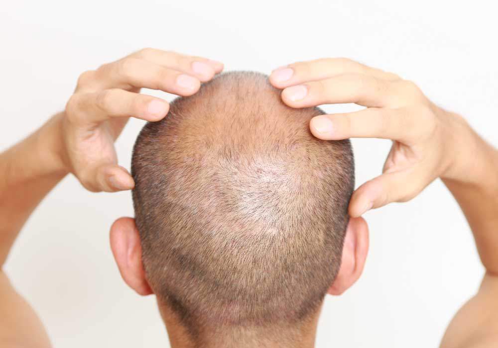 man undergoing a hair restoration treatment