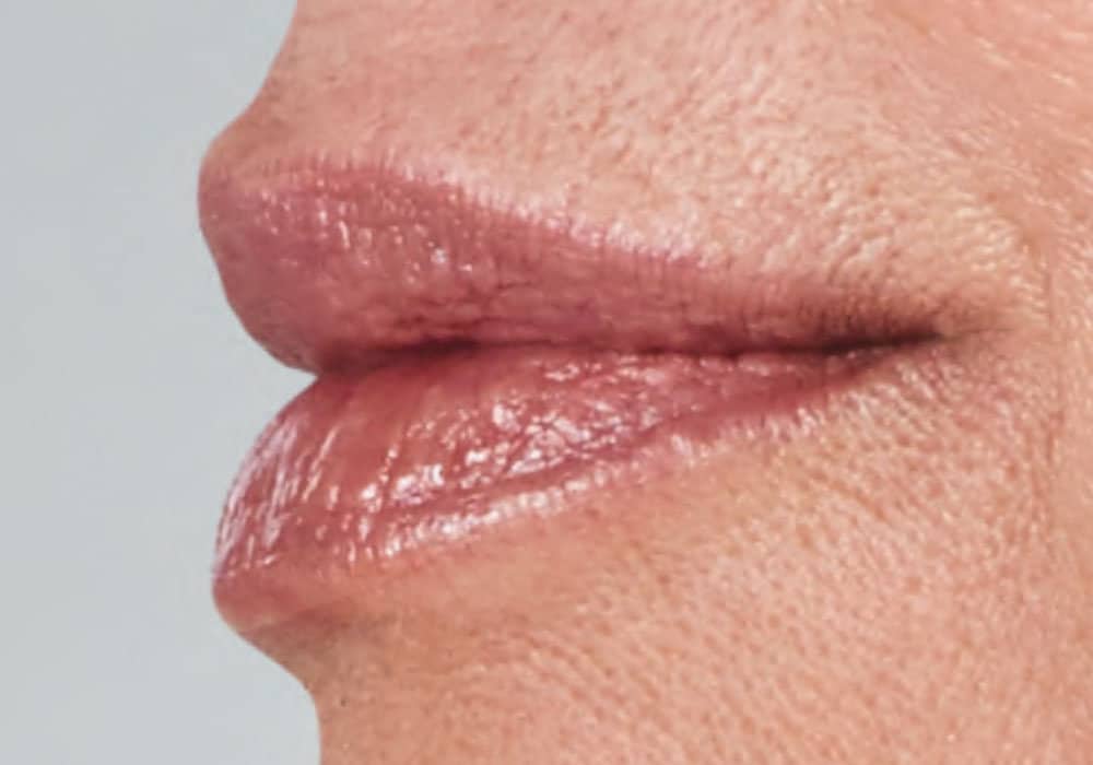 wrinkles on a woman's mouth due to aging