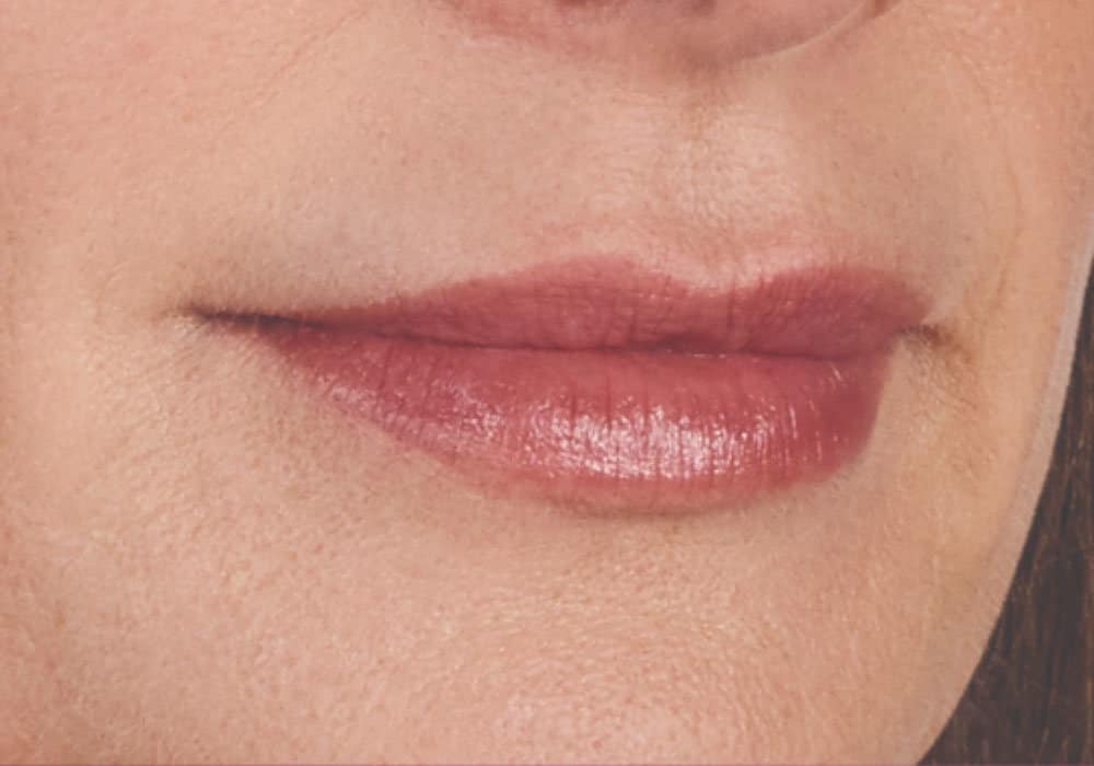 a woman's lips after receiving a botox treatment
