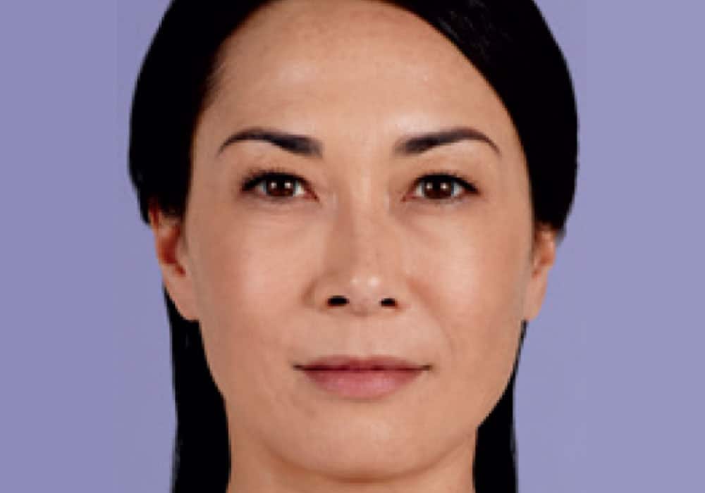 a woman's face after receiving a botox injection