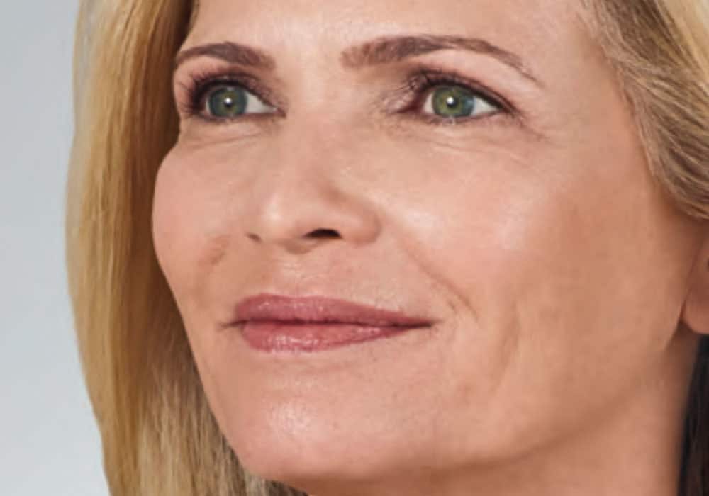 a blonde woman smiling before a botox injection