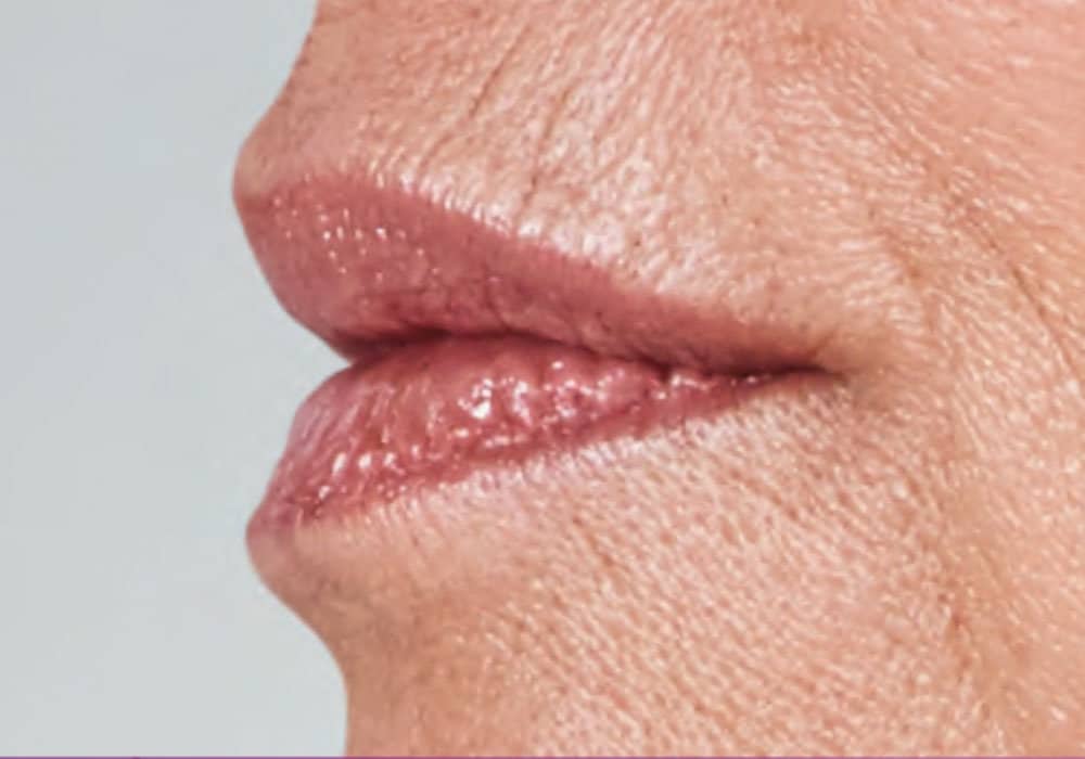 wrinkles above a woman's lips