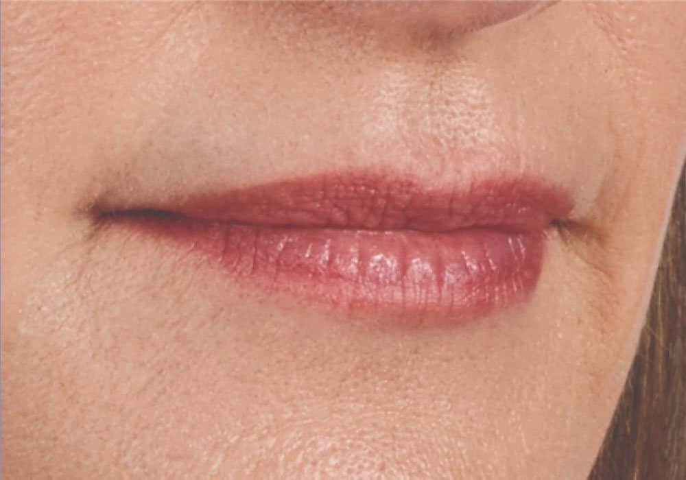 a woman's lips before botox