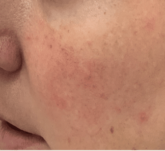 rosacea