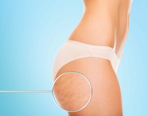 health, people, bodycare and beauty concept - close up of woman buttocks with cellulite and magnifier over blue background