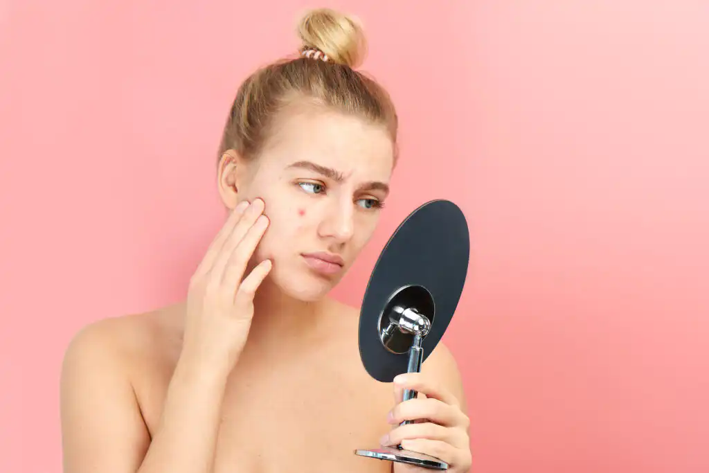 acne treatment options
