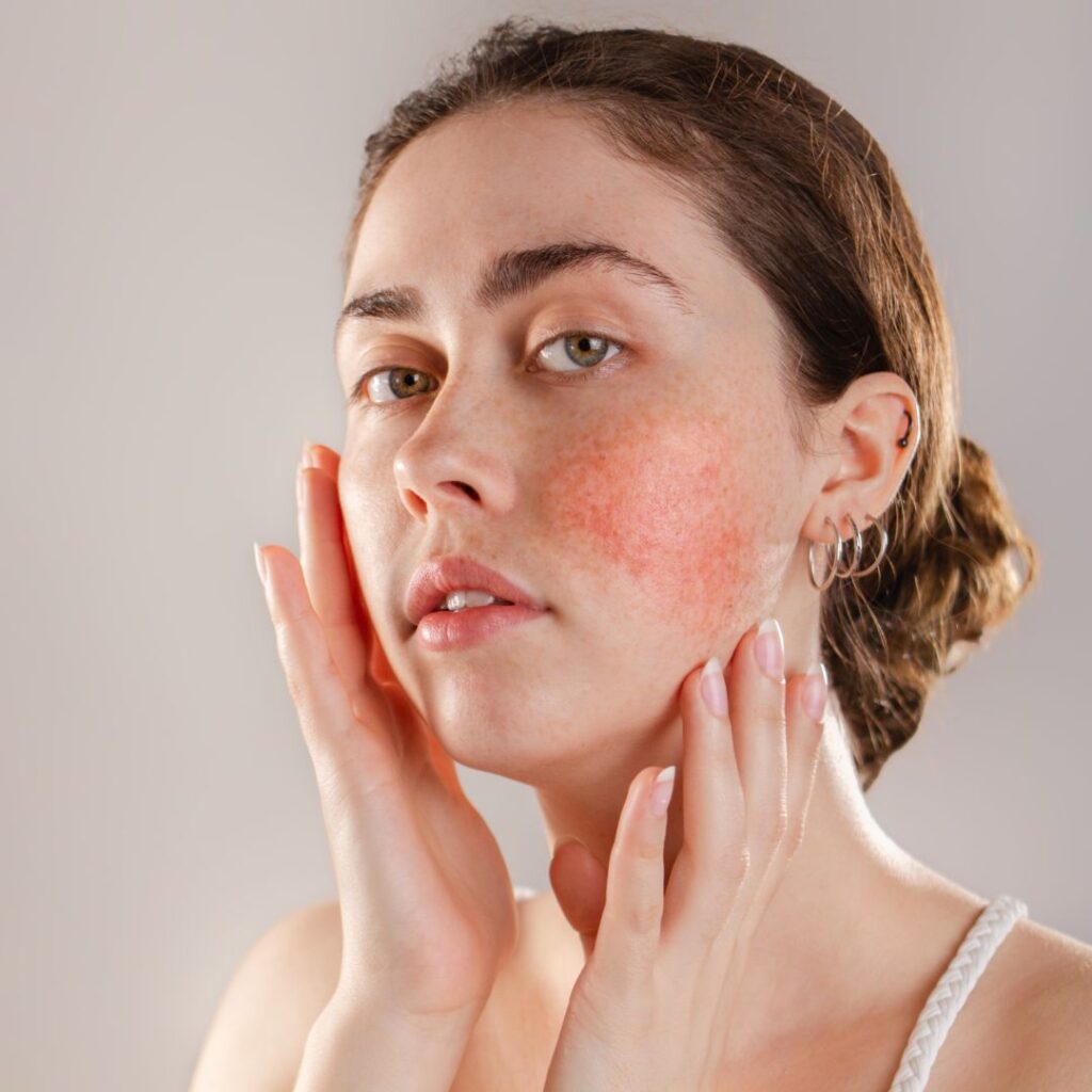 skin with rosacea