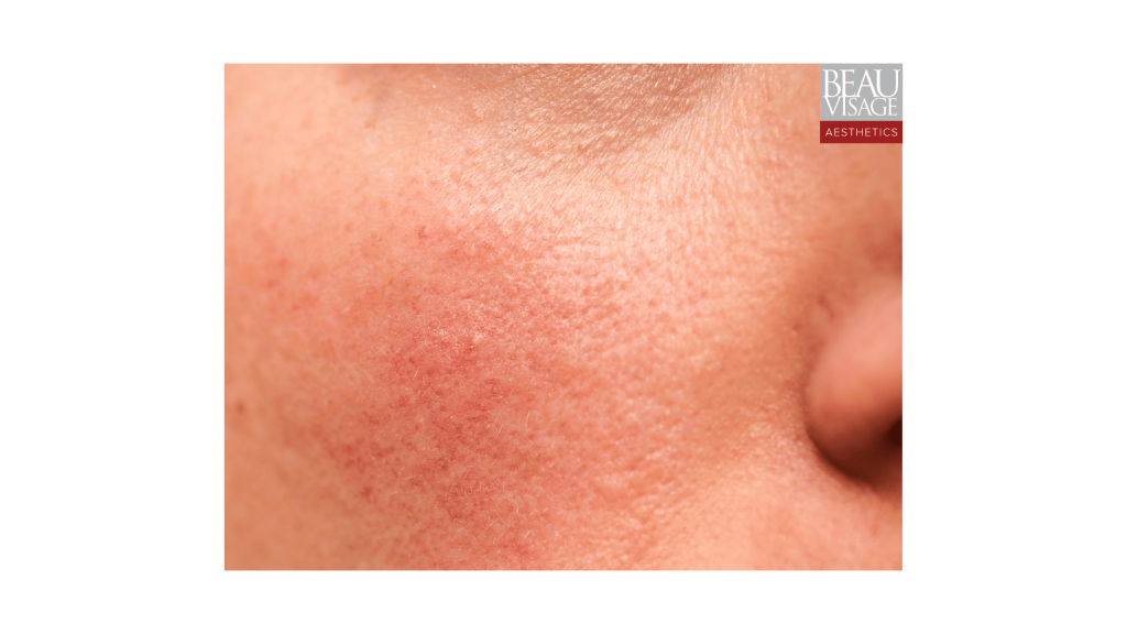 Close-up image of a face showing redness, irritation, and visible blood vessels, indicative of rosacea.