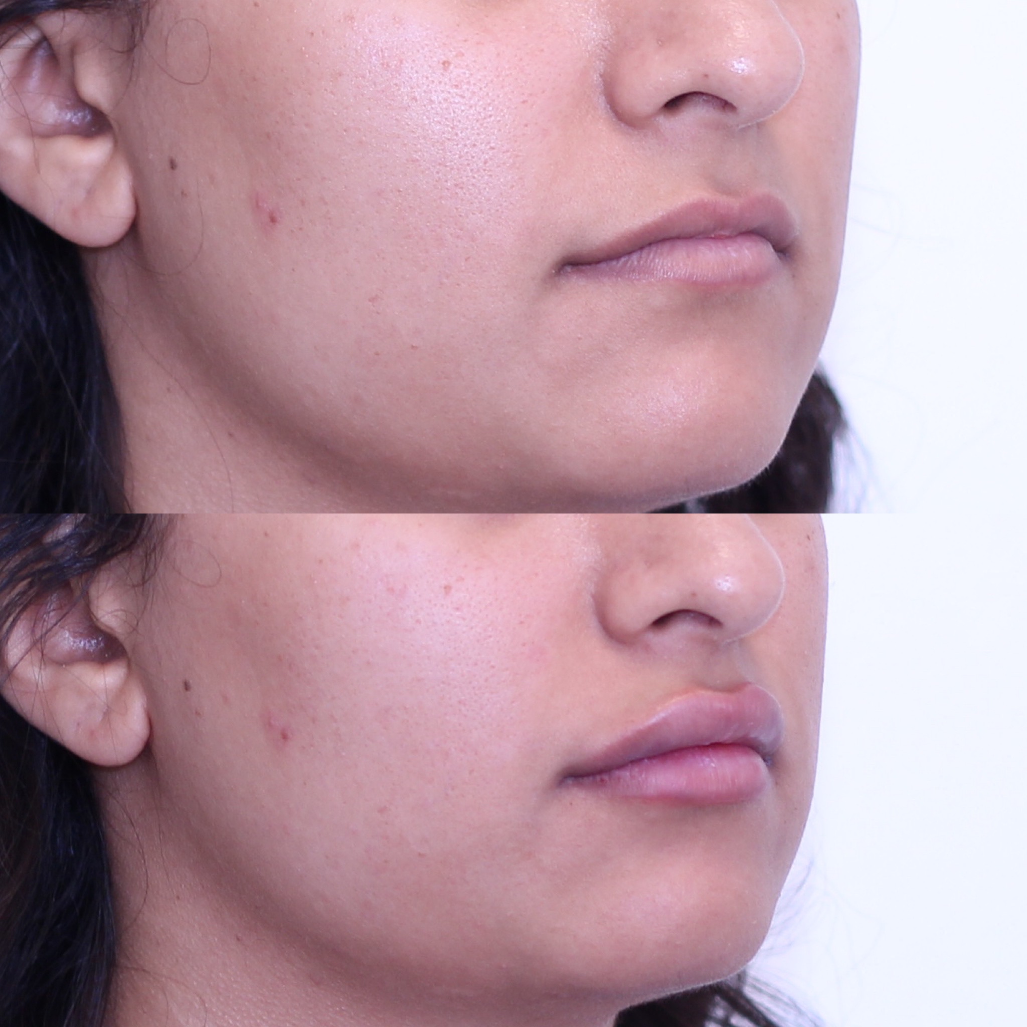 Visible improvement after 1mL of lip filler — natural, balanced results