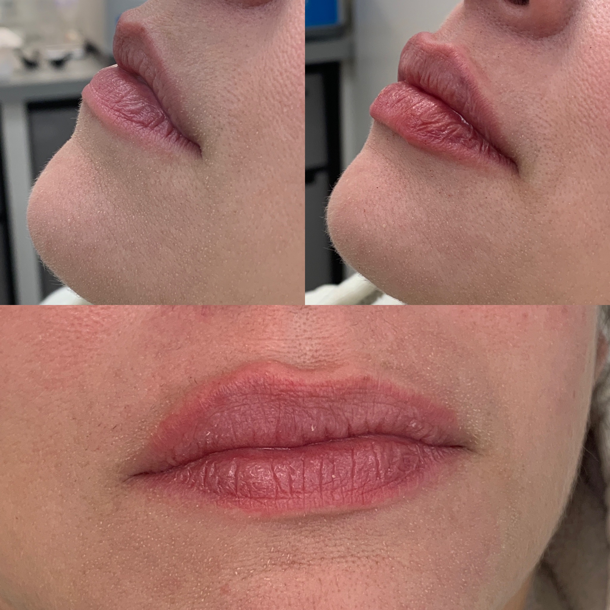 Lip Filler Before & After, with half lip for comparison