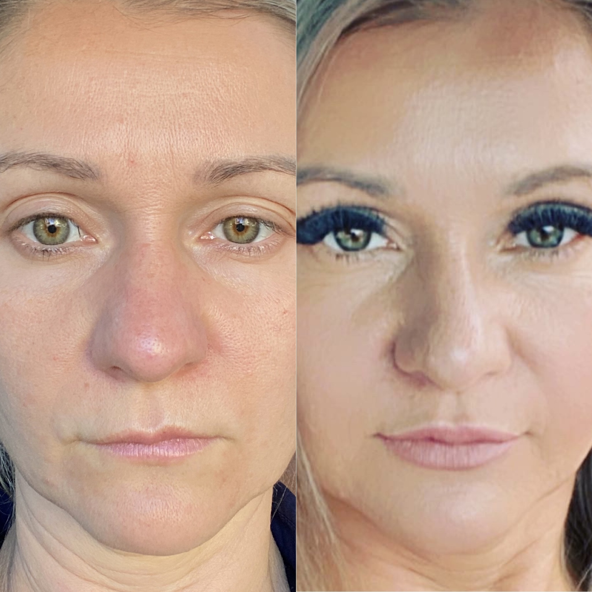 Natural-looking lip enhancement with 1mL of filler