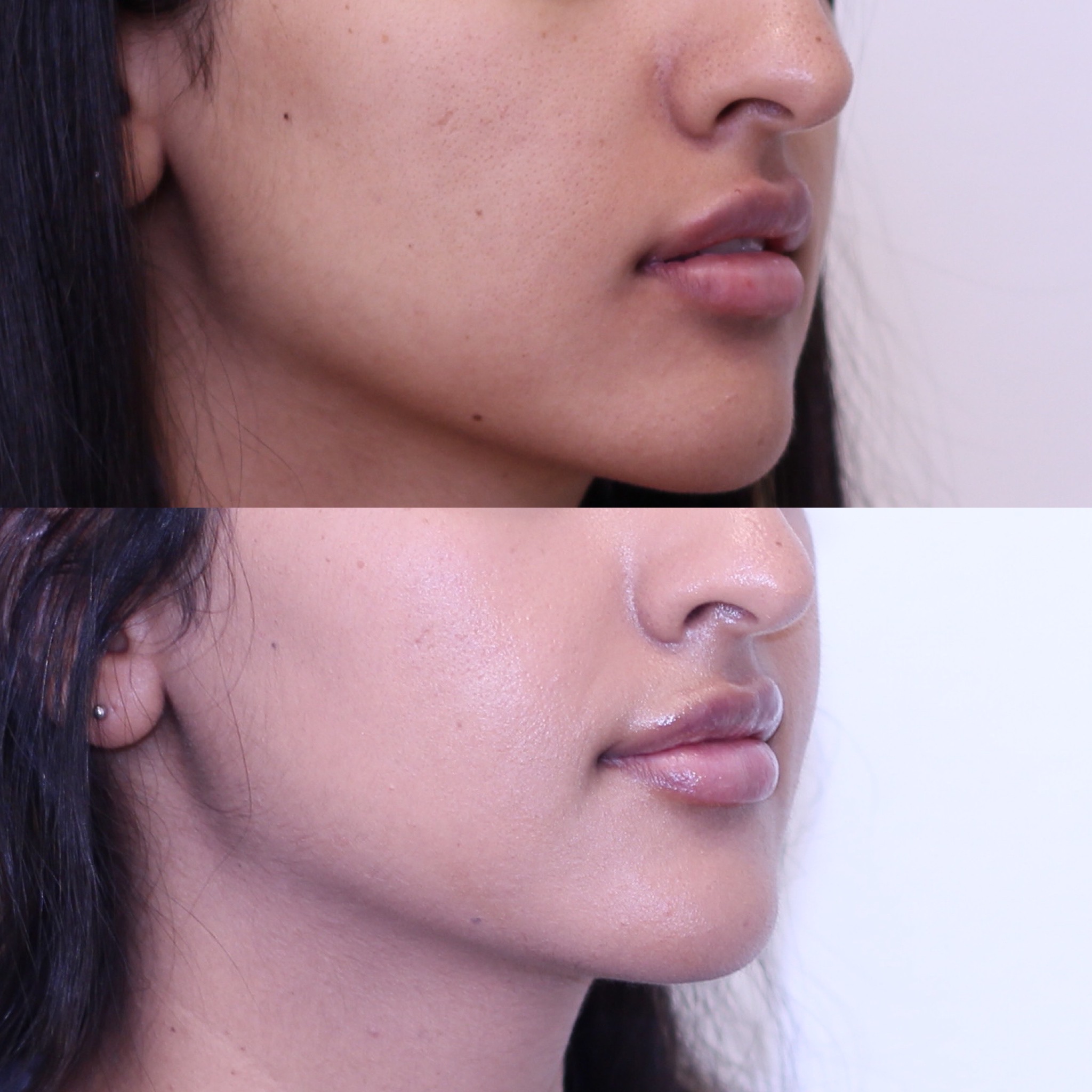 Natural-looking lip enhancement with 1mL of filler