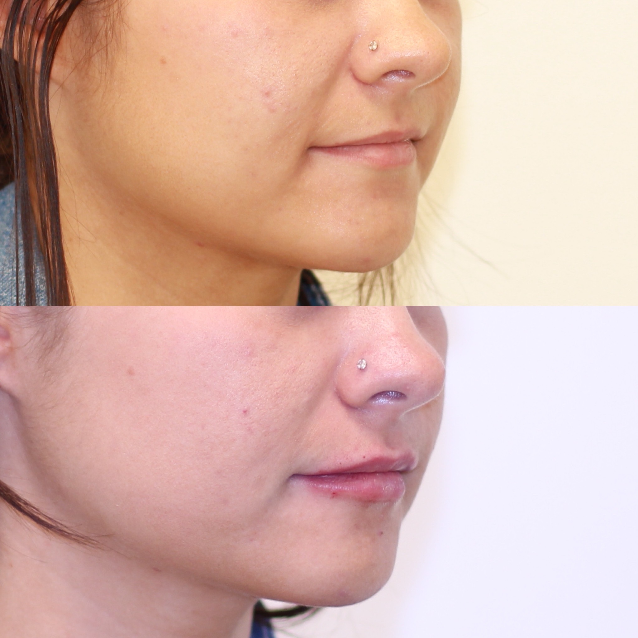 Natural-looking lip enhancement with 1mL of filler