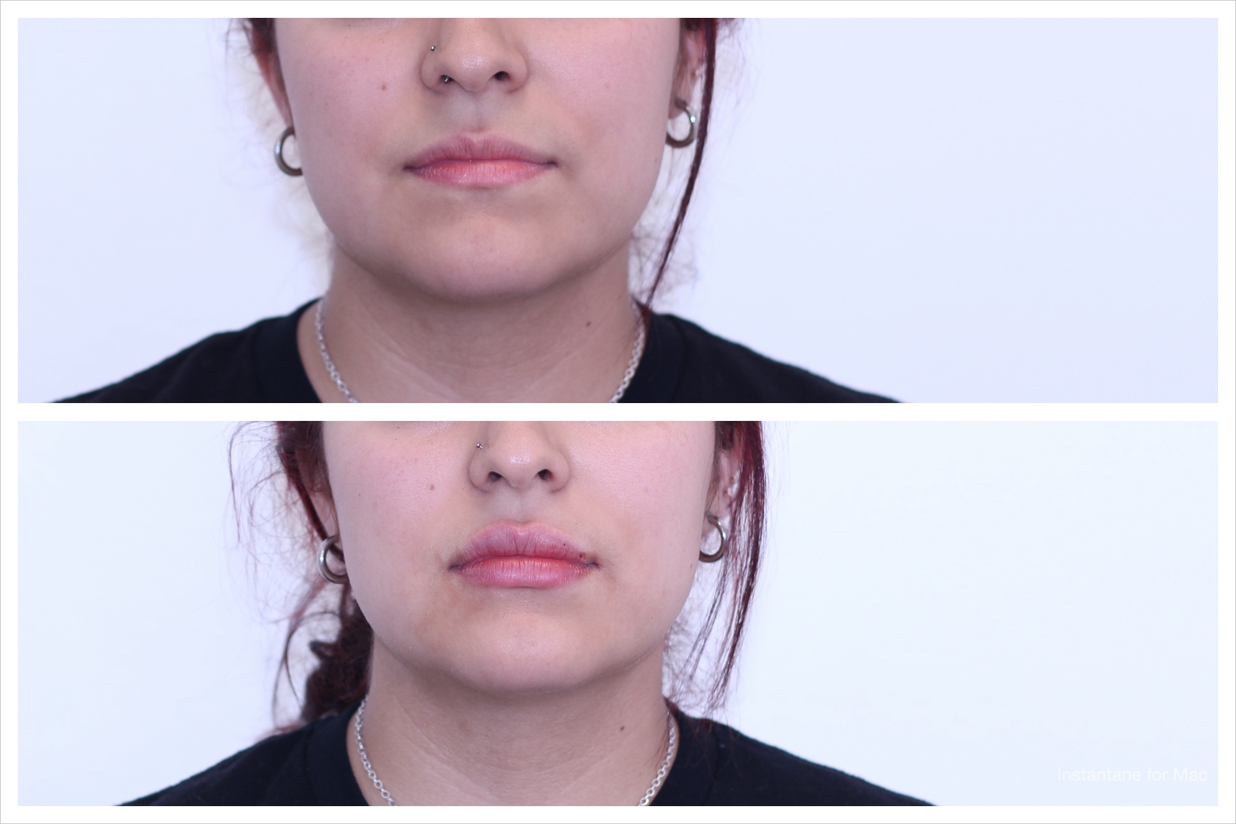Natural-looking lip enhancement with 1mL of filler. Notice the balanced volume and smooth contour in the after photo