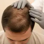 Crown of a man's head with thinning hair, a clinician's gloved hand resting beside it