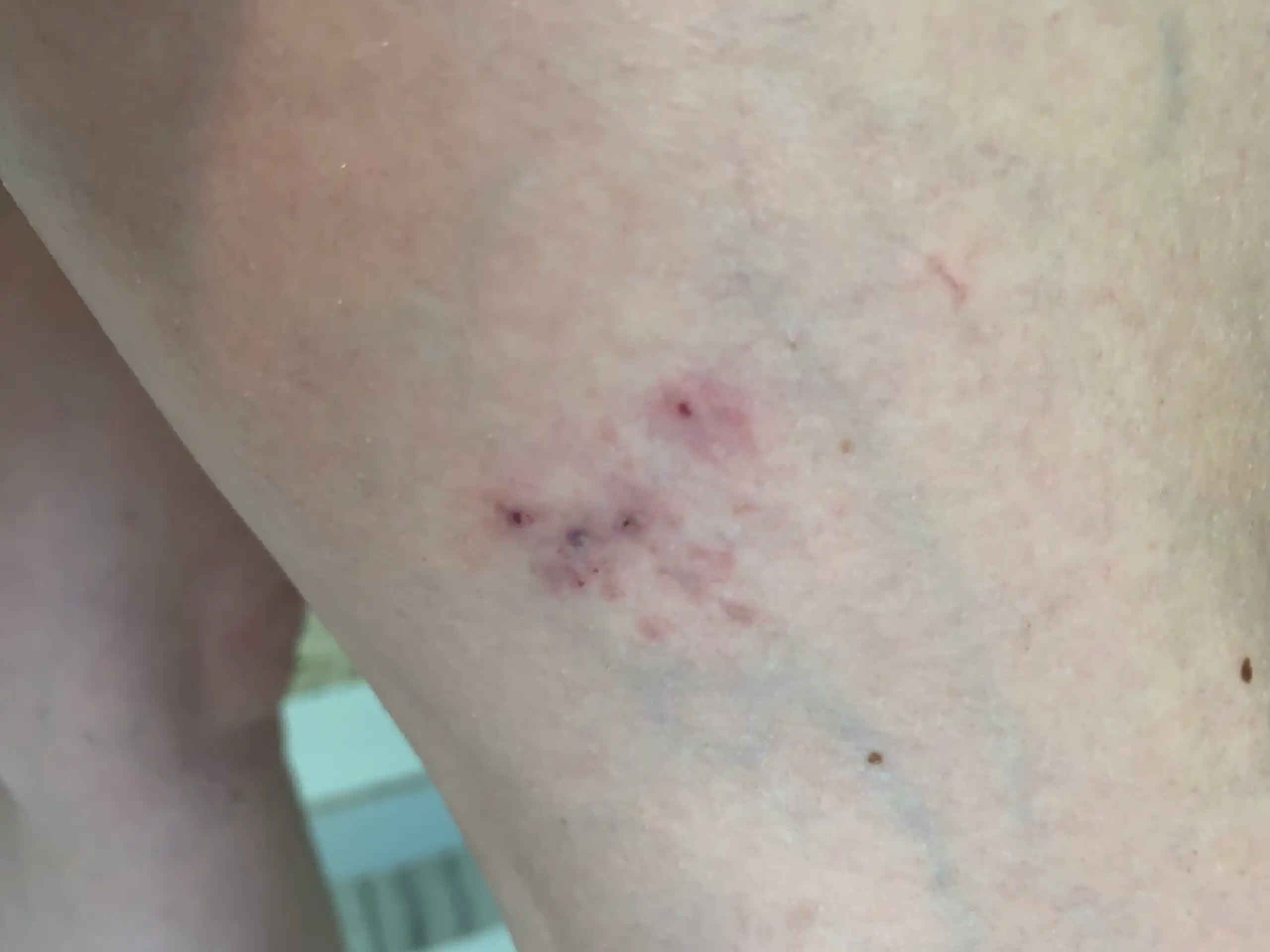 The same leg five days after one laser vein removal session