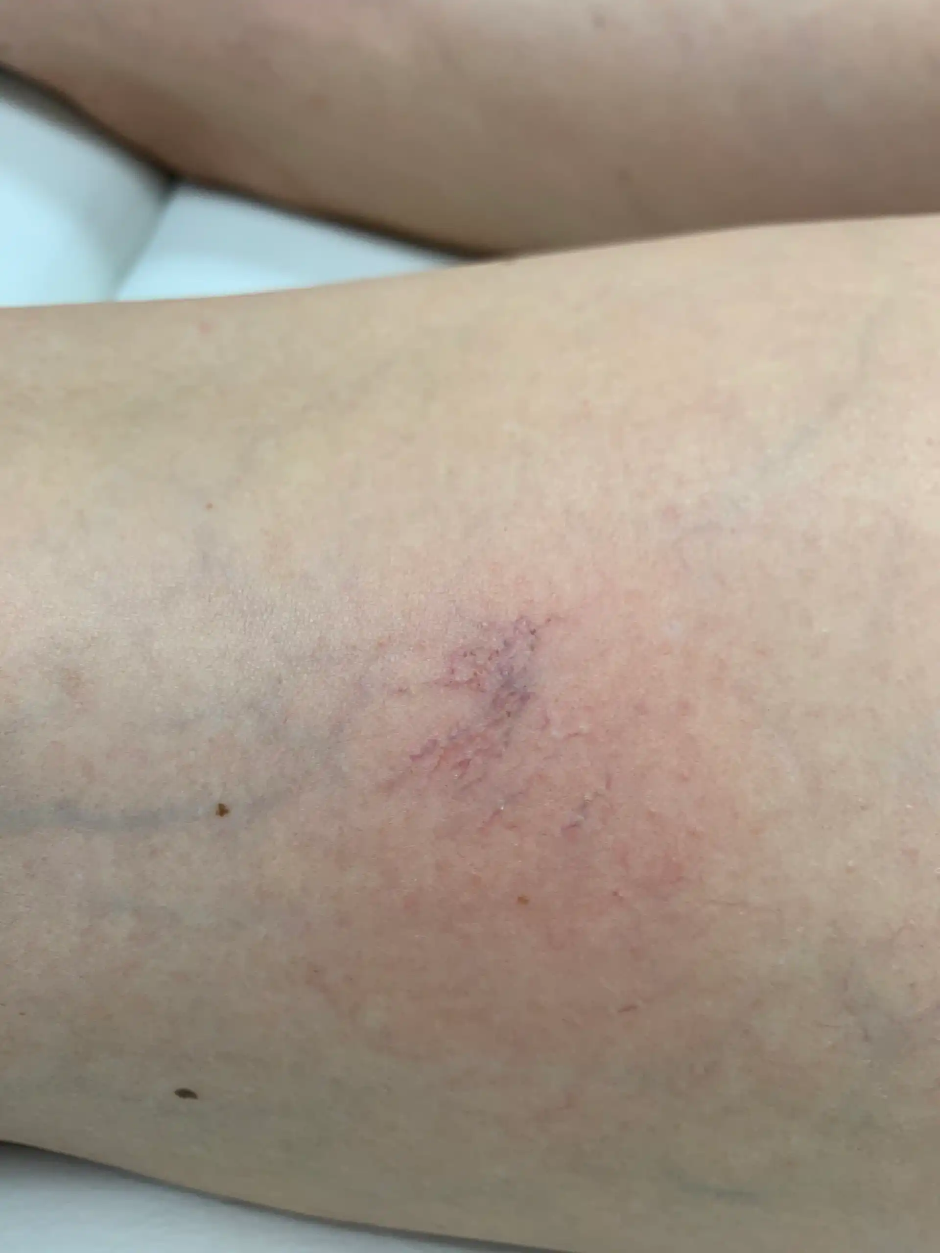 The same leg eight days after one laser vein removal session