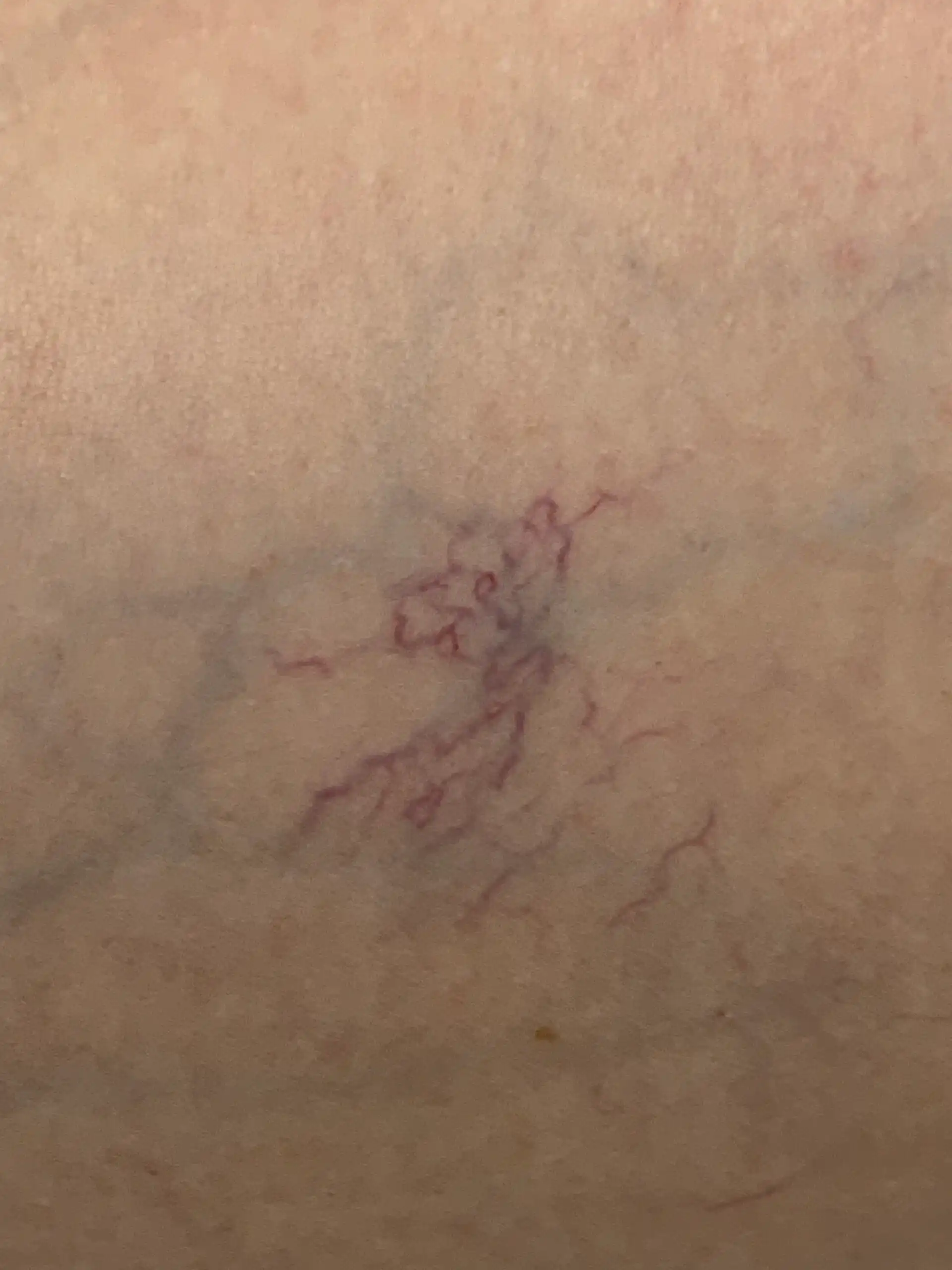 Spider veins on the leg before laser vein removal