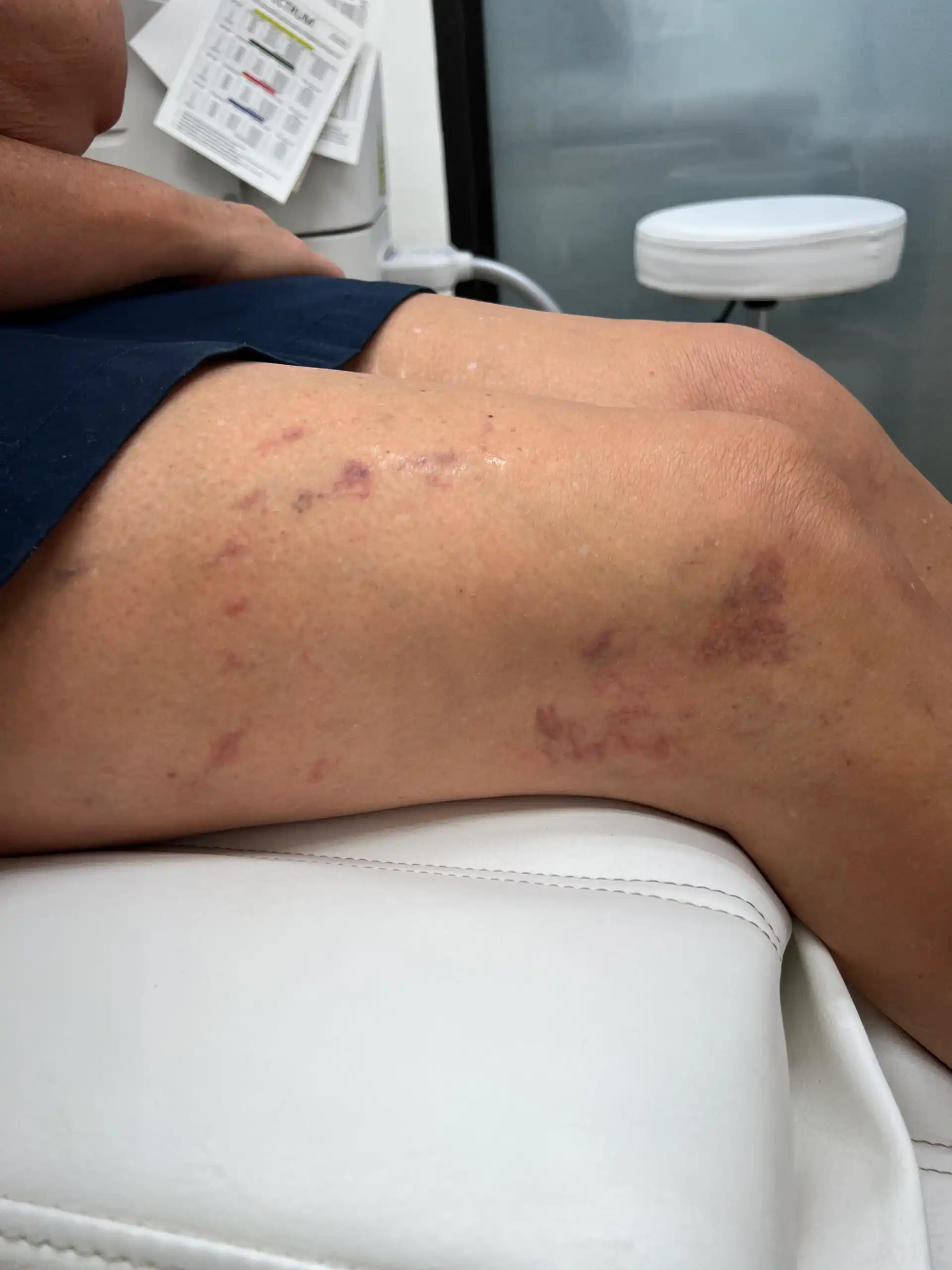 The same leg five days after one laser vein removal session