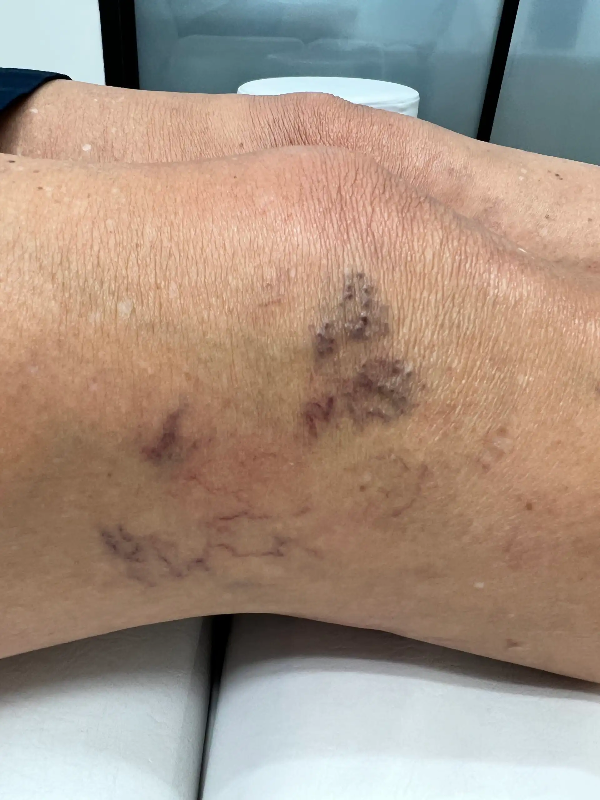 Spider veins on the leg before laser vein removal
