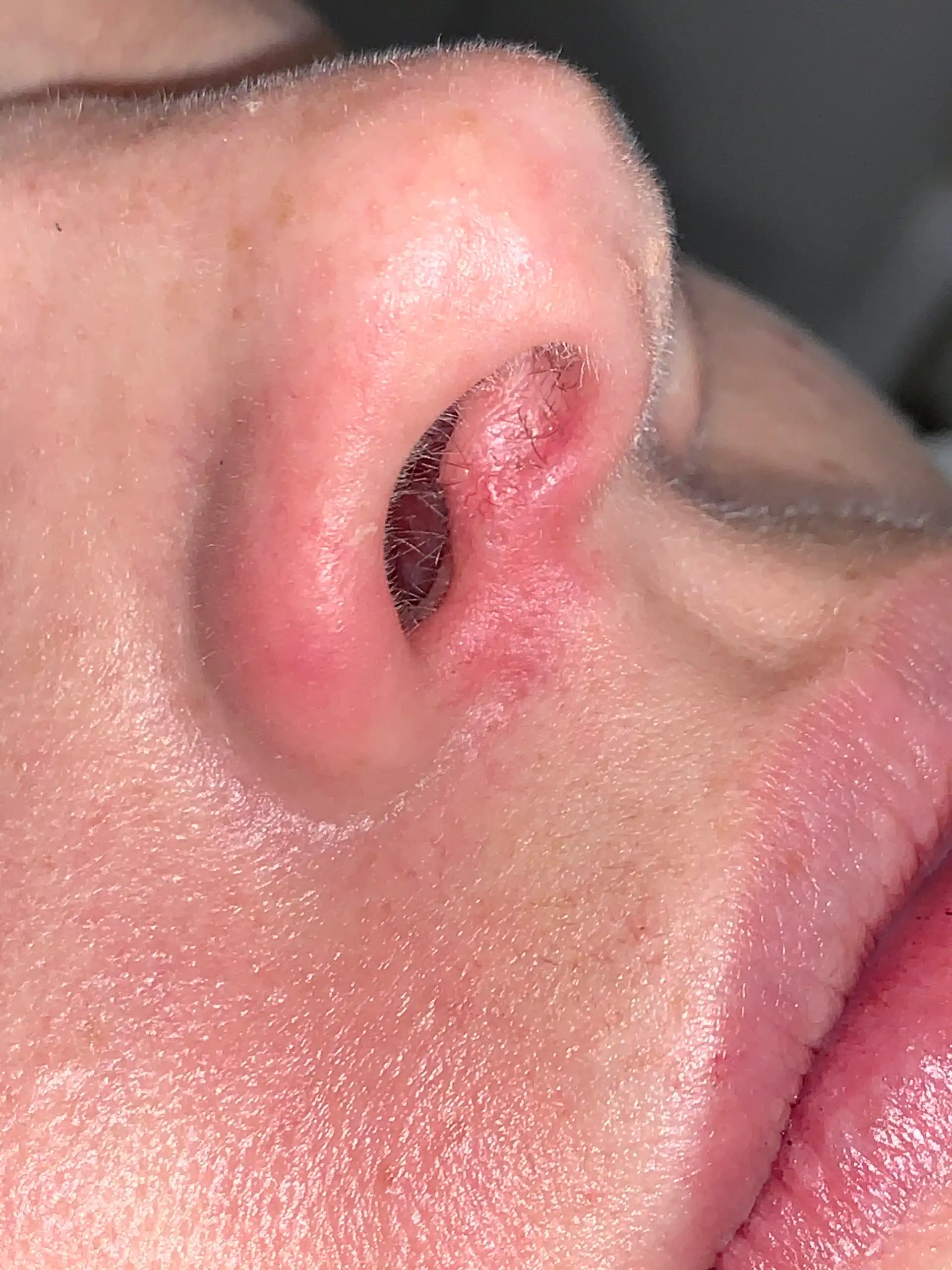 The same nose immediately after one laser vein removal session
