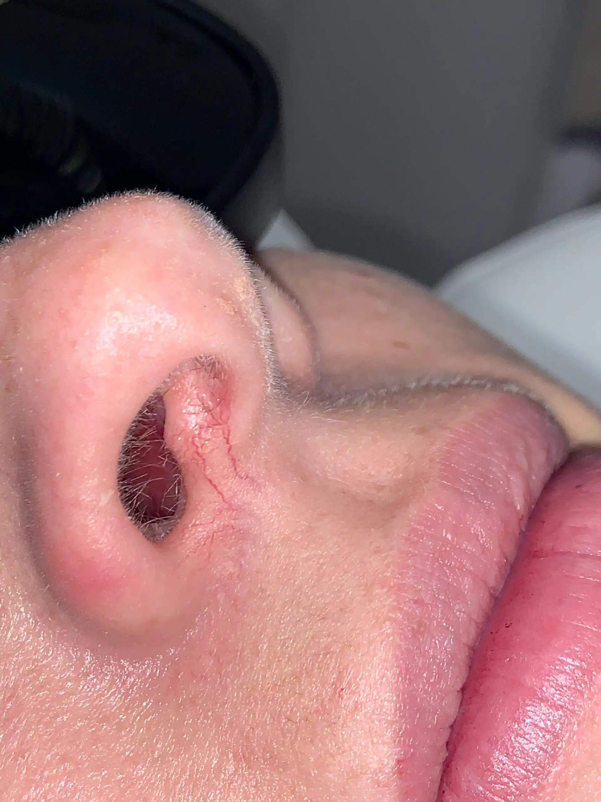A spider vein on the side of the nose before laser vein removal
